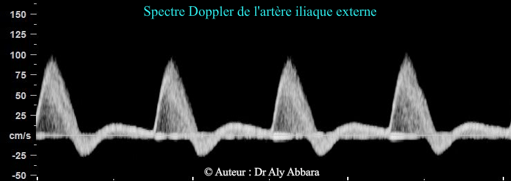 Spectre Doppler normal de l'artère iliaque externe
