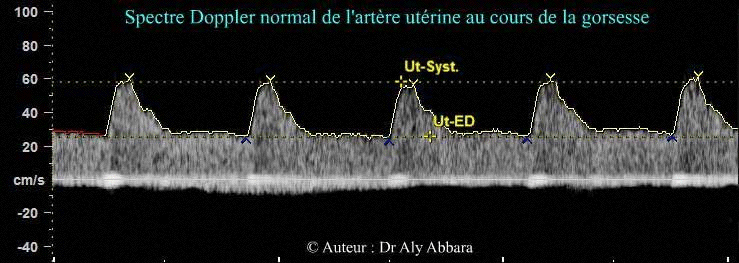 Spectre normal de l'artère utérine durant la grossesse