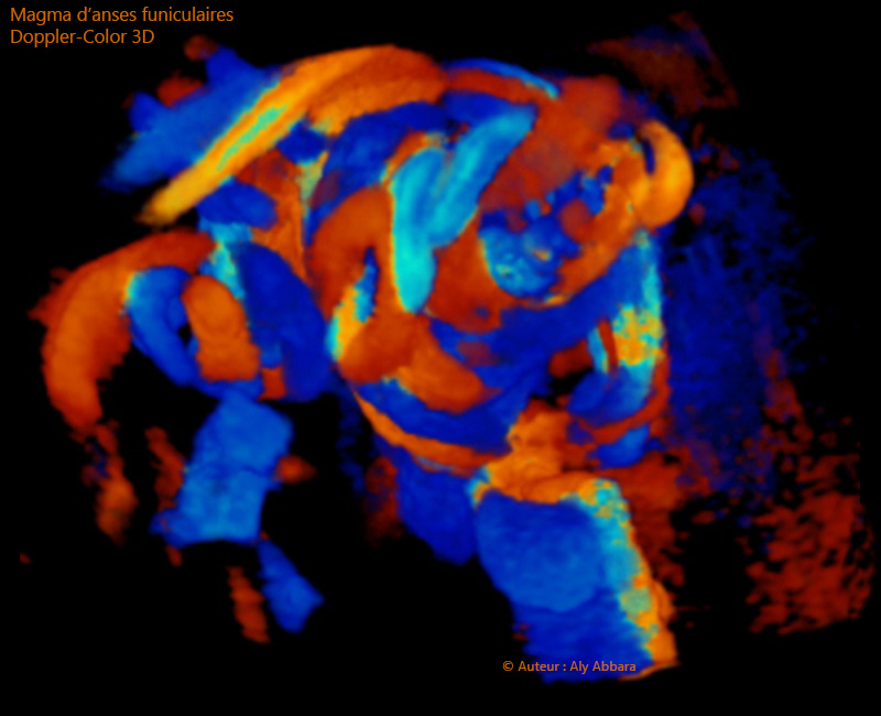 Doppler-Couleur 3D : magma d'anses funiculaires