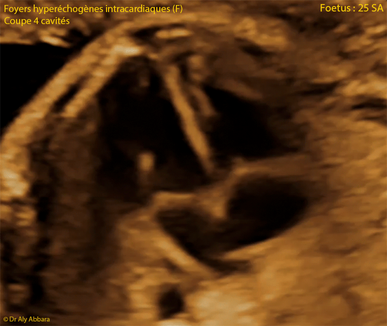 Foyer échogène intracardiaque multiple ou spots intraventriculaires : animation échographique - 25 SA
