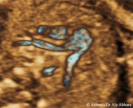 Troc pulmonaire - Bifurcation en artère pulmonaire droite et gauche - Echographie