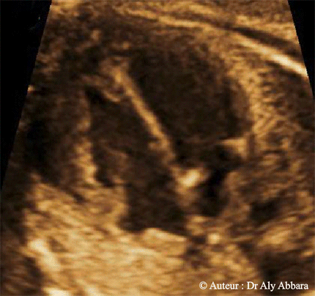 Coeur foetal - Coupe des quatre cavités