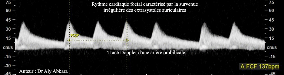 Extrasystoles auriculaires - Spectre Doppler