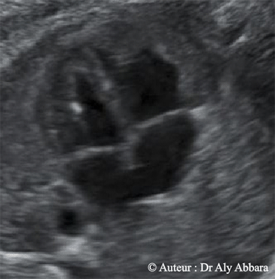 Spot intra-cardiaque - Foyer hyper-échogène au niveau d'un pilier de la valve mitrale