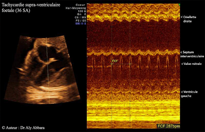 Tachycardie supra ventriculaire à 36 SA - Mode TM - Doppler