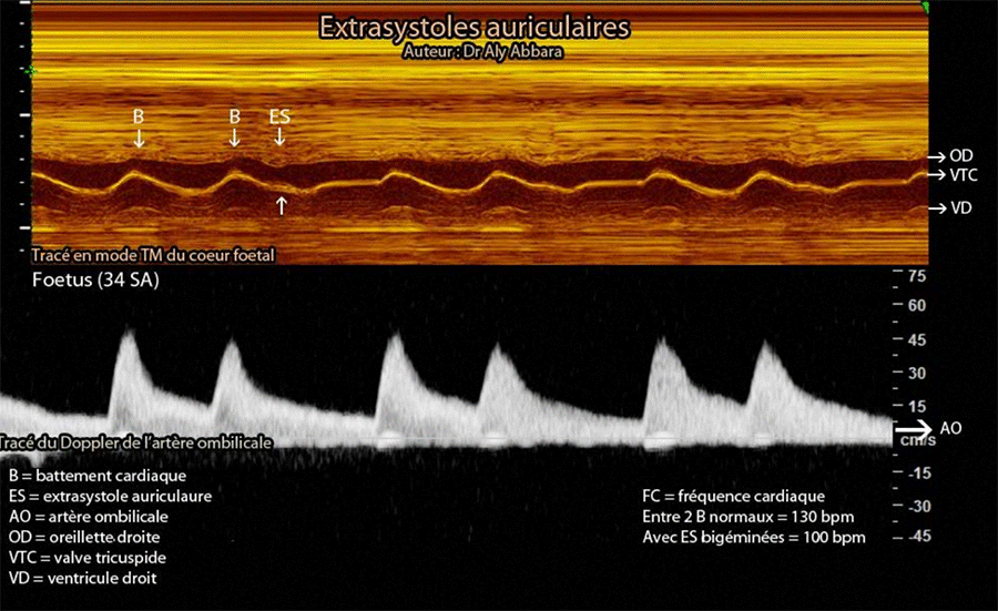 Extrasystoles bigéminées - Spectre Doppler - et échographie cardiaque