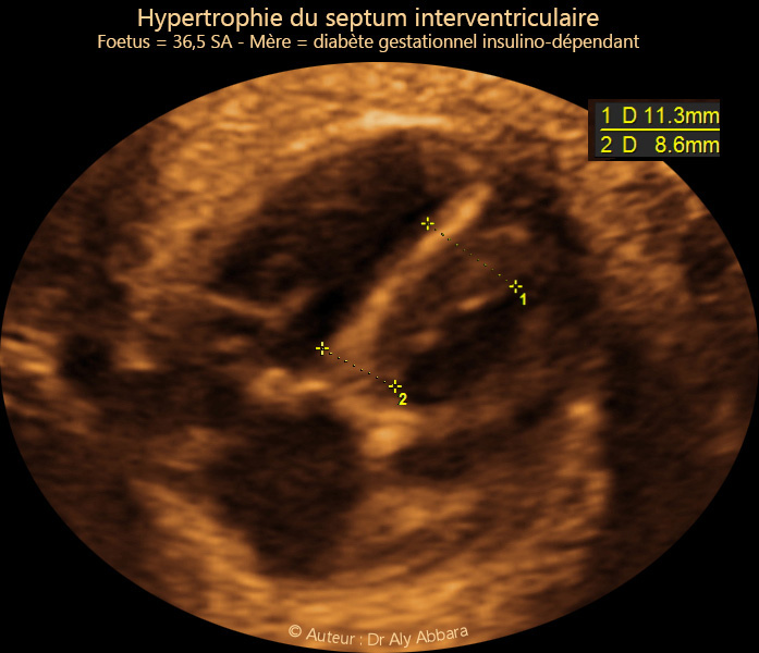 Hypertrophie du septum interventriculaire chez un foetus de 36,5  SA  et mère diabétique insulinodépendante