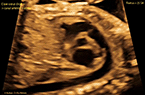 Coeur foetal à 25 SA : l'axe cœur droit - canal artériel - aorte