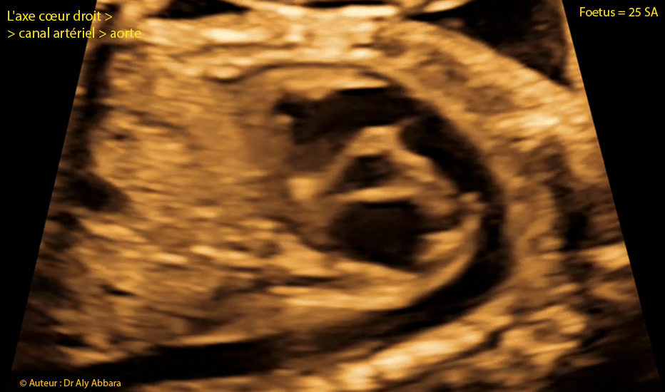 Coeur foetal - 25 SA - Axe coeur droit - tronc pulmonaire - canal artériel - aorte