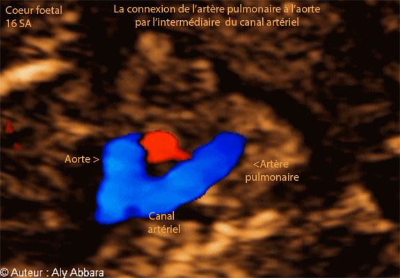 La communication normale et observable entre l'artère pulmonaire et l'aorte par l'intermédiaire du canal artériel - échocardiographie