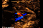 Croisement de l'aorte avec l'artère pulmonaire - image échgraphique animée