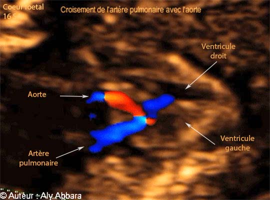 Images échographiques cardiaques montrant le croisement normal et observable entre l'artère pulmonaire et l'aorte.
