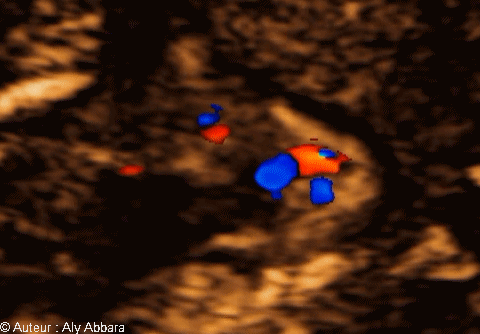 La communication normale et observable entre l'artère pulmonaire et l'aorte par l'intermédiaire du canal artériel - échocardiographie