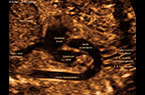 Aorte chez un foetus de 22 SA