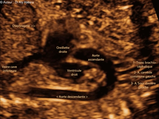 L'aorte de sa naissance du ventricule gauche jusqu'à sa portion descendante - foetus de 22 SA