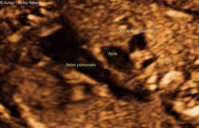 Coeur foetal - la coupe standardisée des trois vaissseaux et la trachée : foetus de 22 SA