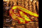 Le canal artériel reliant l'artère pulmonaire à la crosse de l'aorte : foetus de 25 SA - القناة الشريانية الواصلة ما بين الشريان الرئوي وقوس الأبهر