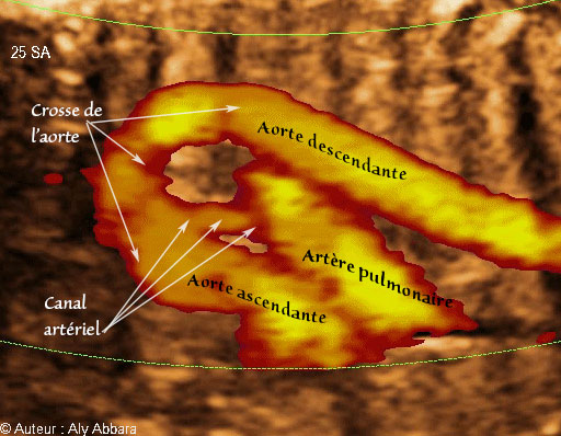Le canal artériel qui relie l'artère pulmonaire à la crosse de l'aorte : foetus de 25 SA - القناة الشريانية الواصلة ما بين الشريان الرئوي وقوس الأبهر