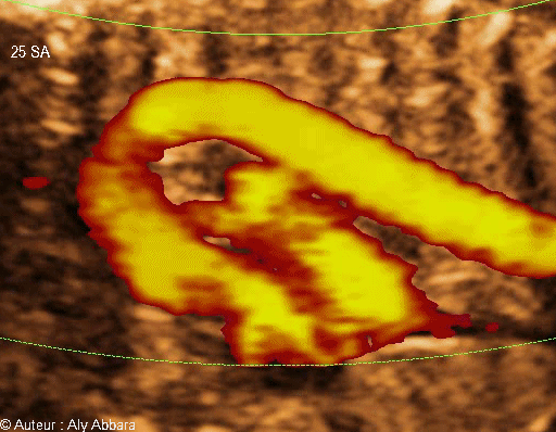 Le canal artériel reliant l'artère pulmonaire à la crosse de l'aorte : foetus de 25 SA - القناة الشريانية الواصلة ما بين الشريان الرئوي وقوس الأبهر