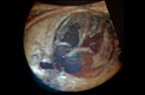 Coeur foetal - Coupe des quatre cavités cardiaques - 33 SA