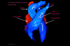Coeur foetal - croisement des gros vaisseaux - Doppler volumique
