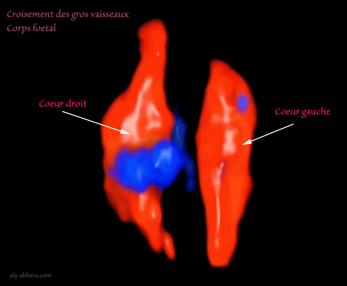 Artère ombilicale unique - grossesse de 33 SA - Absence de d'anomalie associée