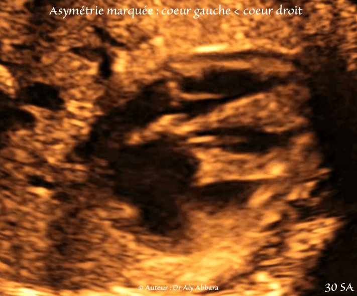 Hernie-diaphragmatique mise en évidence à 13 SA et 14 jours dans un contexe polymalformatif