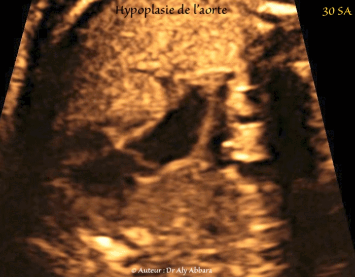 Hernie-diaphragmatique mise en évidence à 13 SA et 14 jours dans un contexe polymalformatif