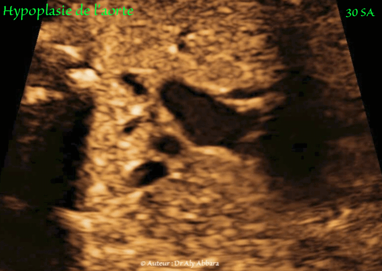 Hernie-diaphragmatique mise en évidence à 13 SA et 14 jours dans un contexe polymalformatif