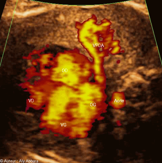 veine pulmonaire droite antérieure