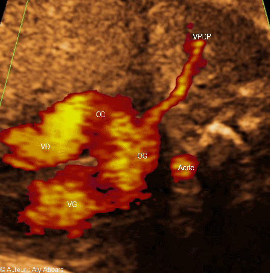 Veine pulmonaire droite postérieure