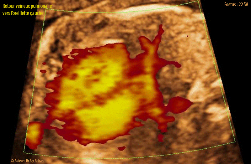 Retour veineux pulmonaire vers l'oreillette gauche - Grossesse de 22 SA