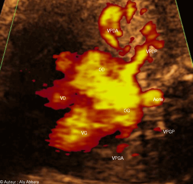 Le retour veineux vers l'oreillete gauche - grossesse de 32 SA