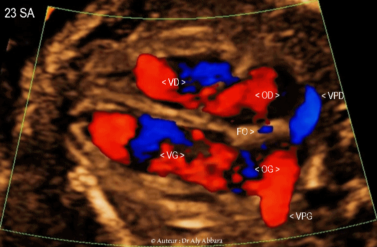 Image échographique animée montrant à l'aide du Doppler-couleur le retour veineux vers l'oreillette gauche durant la vie in-utero - والعود الوريدي نحو الأُذينة اليسرى أثناء الحياة الجنينية