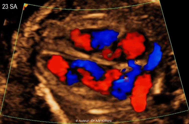 Image échographique animée montrant à l'aide du Doppler-couleur le retour veineux vers l'oreillette gauche durant la vie in-utero - والعود الوريدي نحو الأُذينة اليسرى أثناء الحياة الجنينية