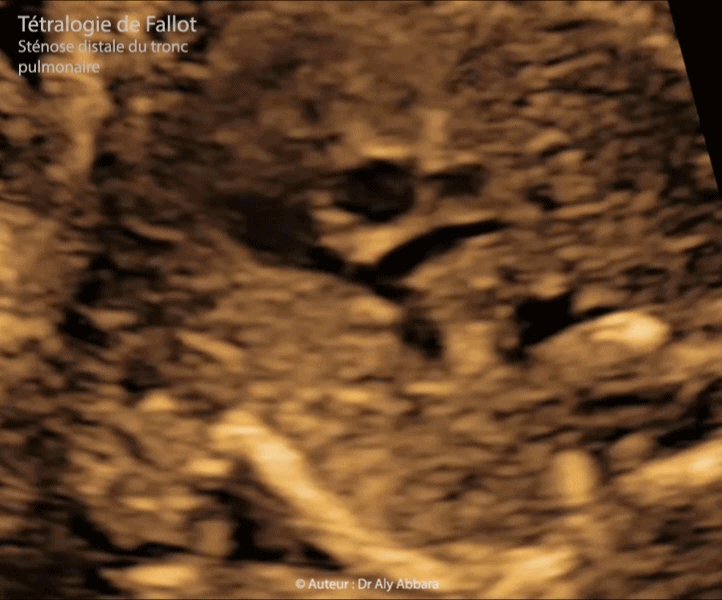 Sténose du tronc pulmonaire