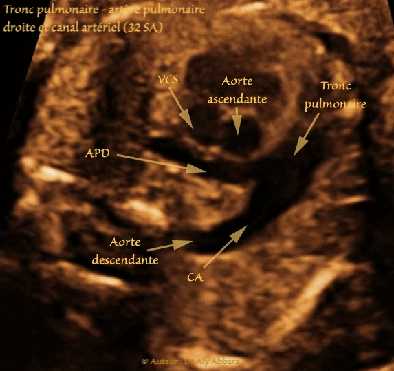 Artère ombilicale unique - grossesse de 33 SA - Absence de d'anomalie associée