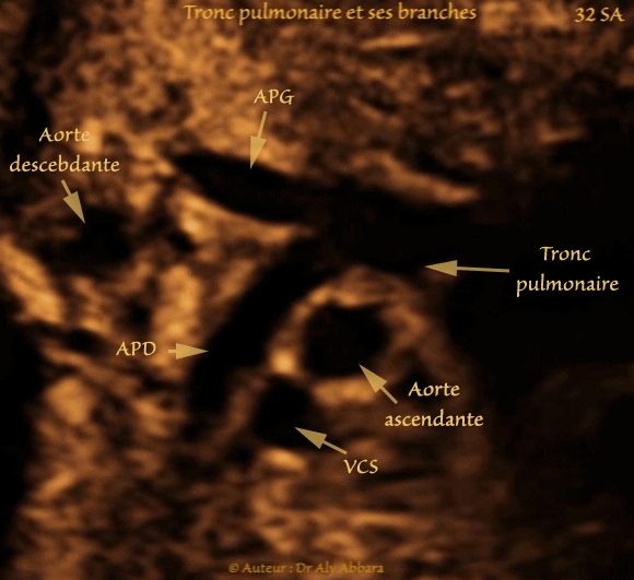 Artère ombilicale unique - grossesse de 33 SA - Absence de d'anomalie associée