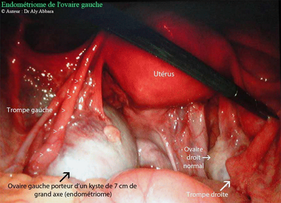 Endométriome - Images cliniques coelioscopiques