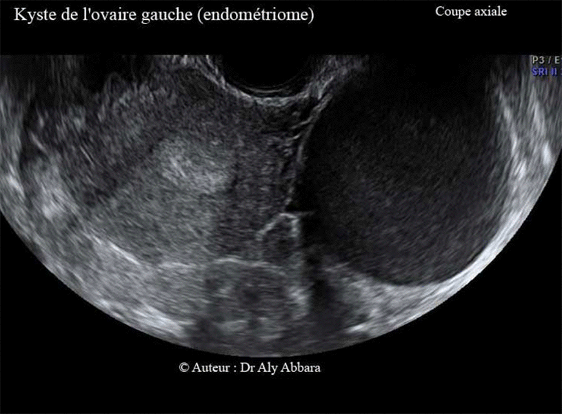 Volumineux kyste endométriosique (endométriome) de l'ovaire gauche - Echographie