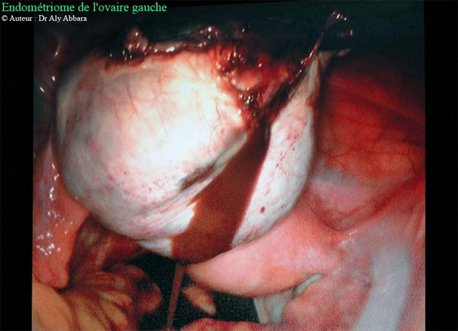 Endométriome de l'ovaire gauche rompu - Contenu d'aspect chocolaté - Images cliniques coelioscopiques