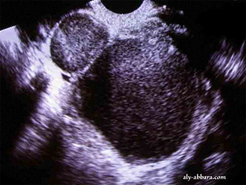 Edométriomes mutiples touchant les deux ovaires