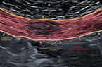 Endométriose intra-musculaire stromale et glandulaire - Post césarienne