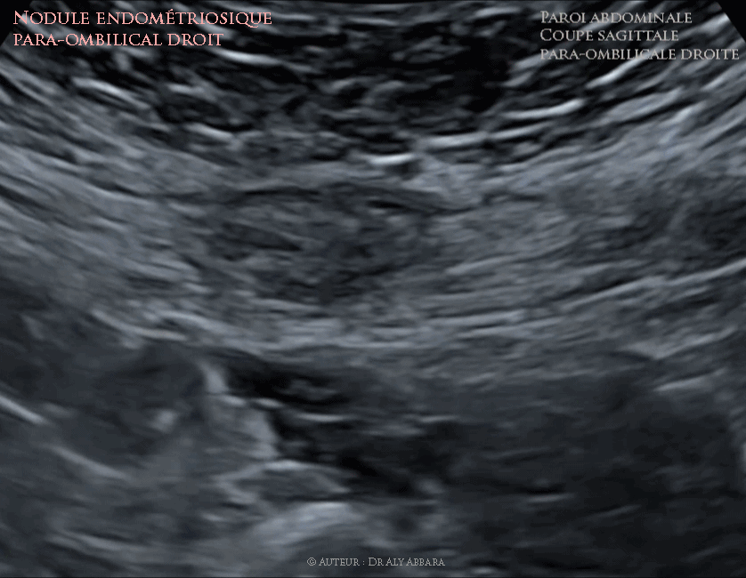 Kyste splénique - grossesse de 31 SA