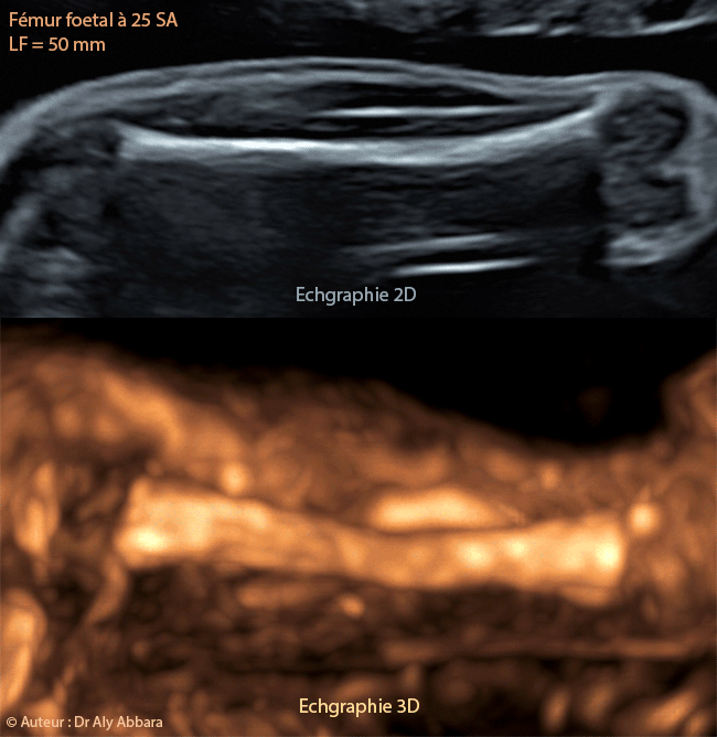 Fémur foetal à 25 SA (50 mm de longueur) - Aspect en échographie 2D et 3D