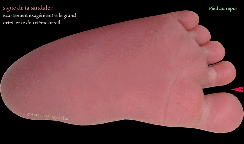 Signe de la sandale chez un nouveau-né trisomique 21 - Il s'agit d'un signe inconstant, plus évident aux mouvements du pied