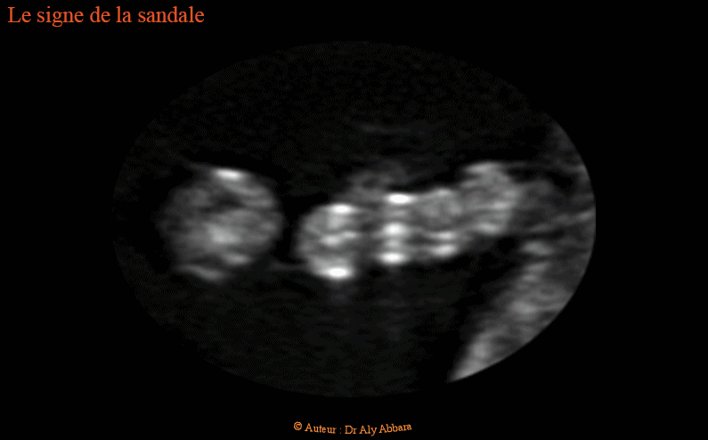 Pied bot varus  unilatéral droit - 22 SA