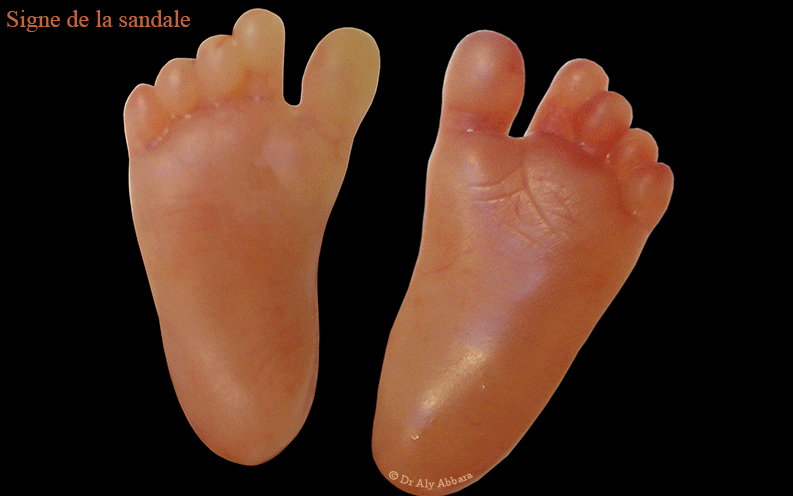 Pied gauche en position normale - 22 SA