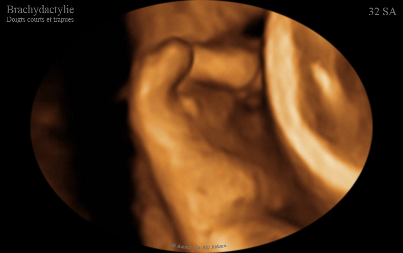 Brachydactylie, قِصر الأصابع - تثلث الصبغي 21