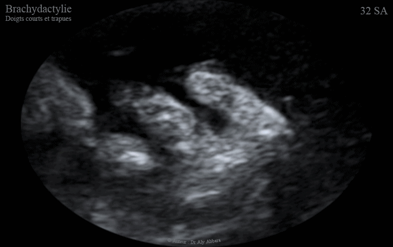 Brachydactylie, قِصر الأصابع - تثلث الصبغي 21